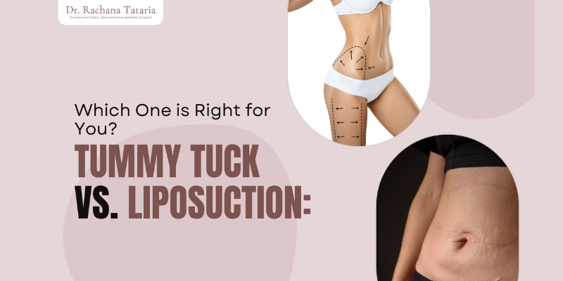 Tummy Tuck